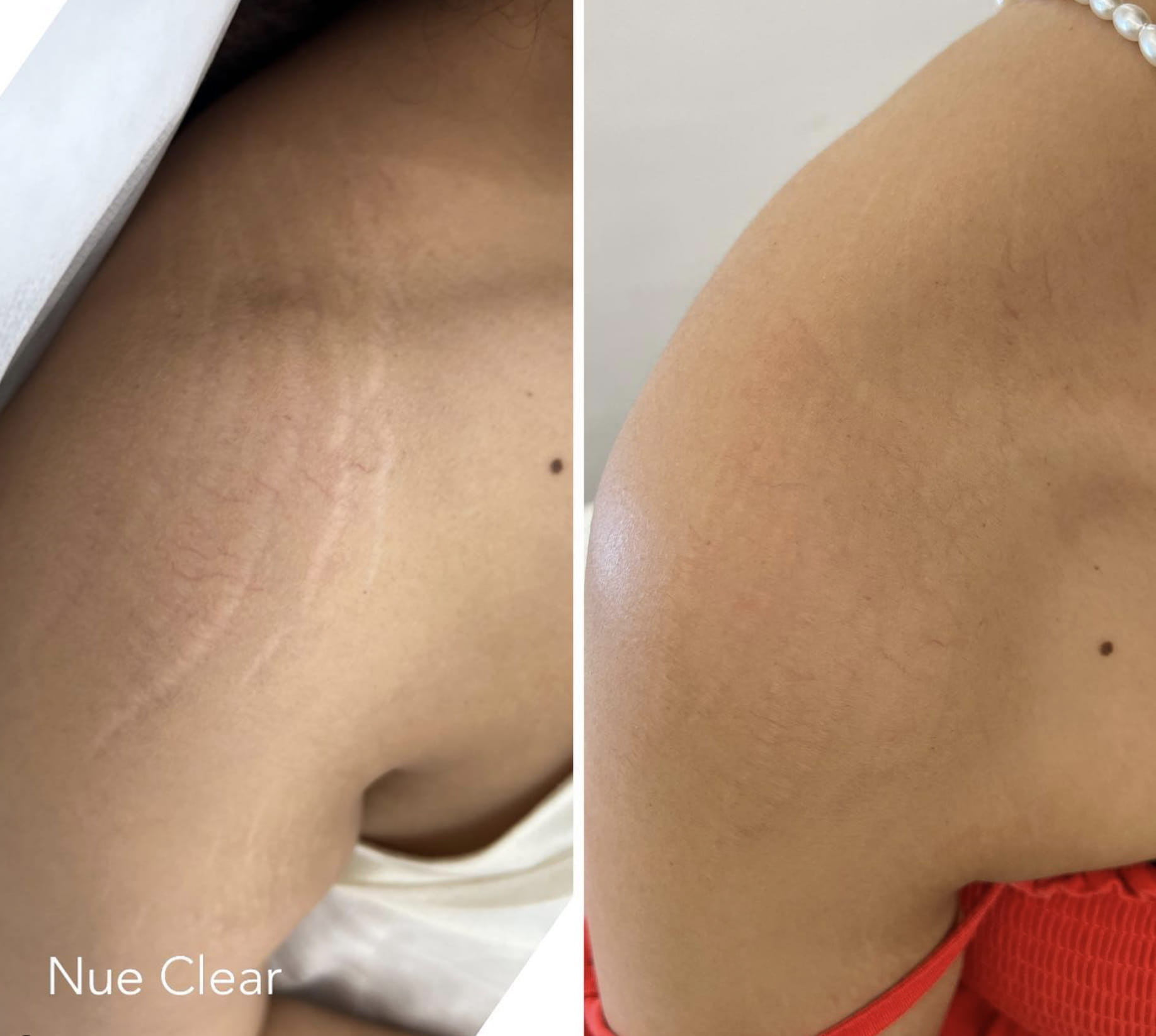 shoulder before after Scar Treatment Perth | UV to Skin