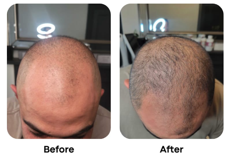 Before & After Kojaxin Effect Progress Before & After Kojaxin Effect Progress
