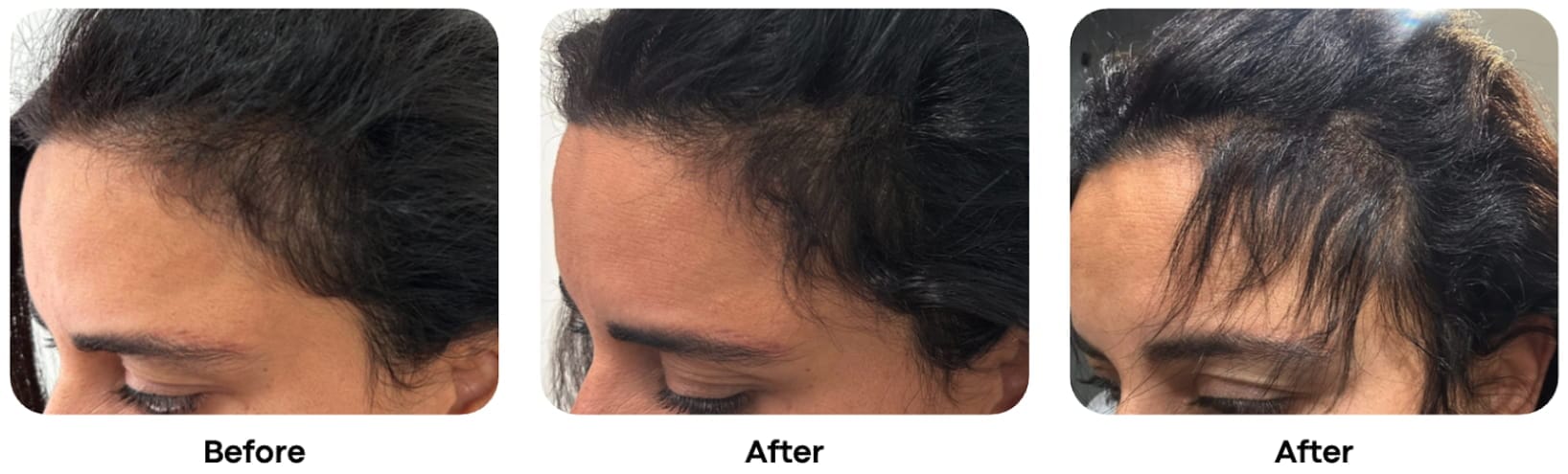 Screenshot 2025-08-20 at 4.23.35 pm Before and After Scar Treatment | Scar Treatment Perth