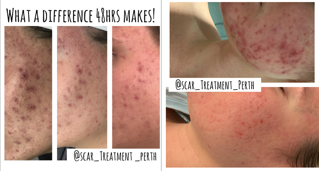 Acne Scar Treatment Perth