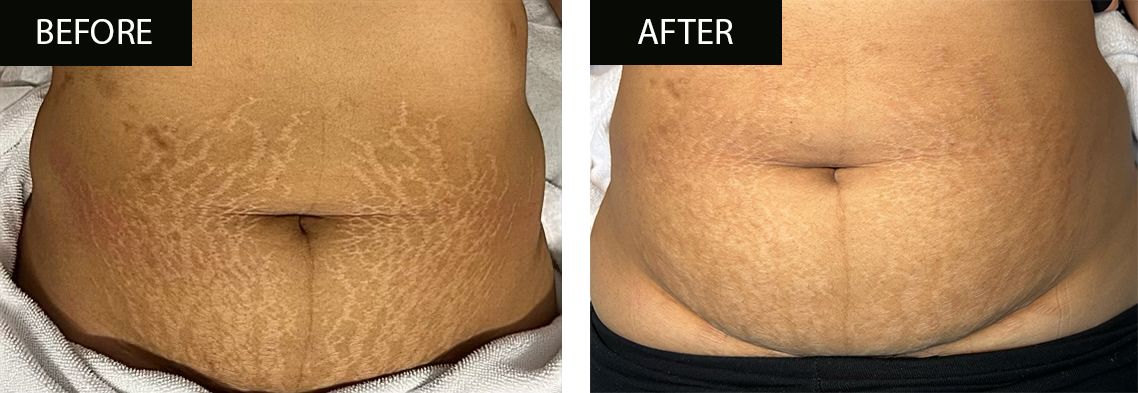 Pregnancy Stretch Mark Treatment - Before and After - 1