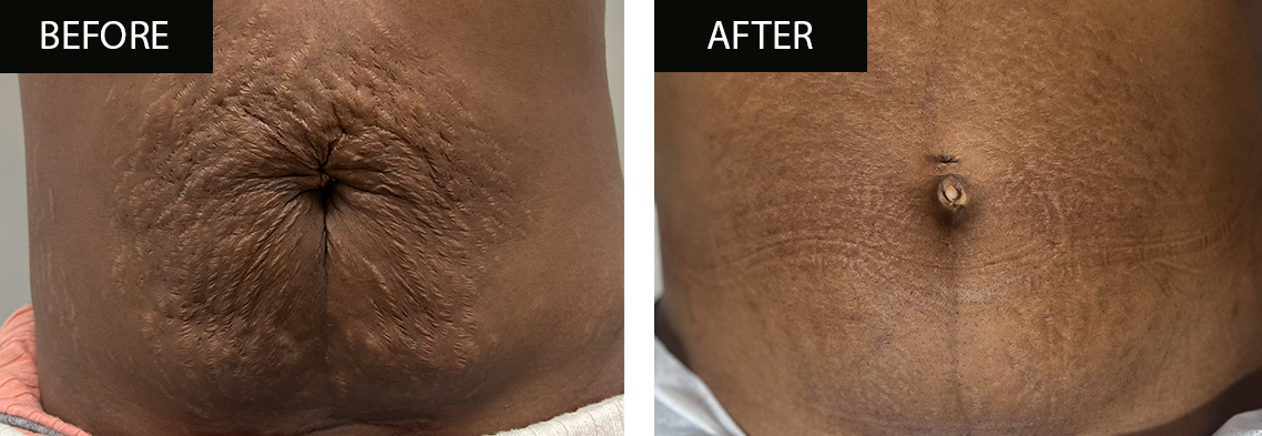 Pregnancy Stretch Mark Treatment - Before and After - 2