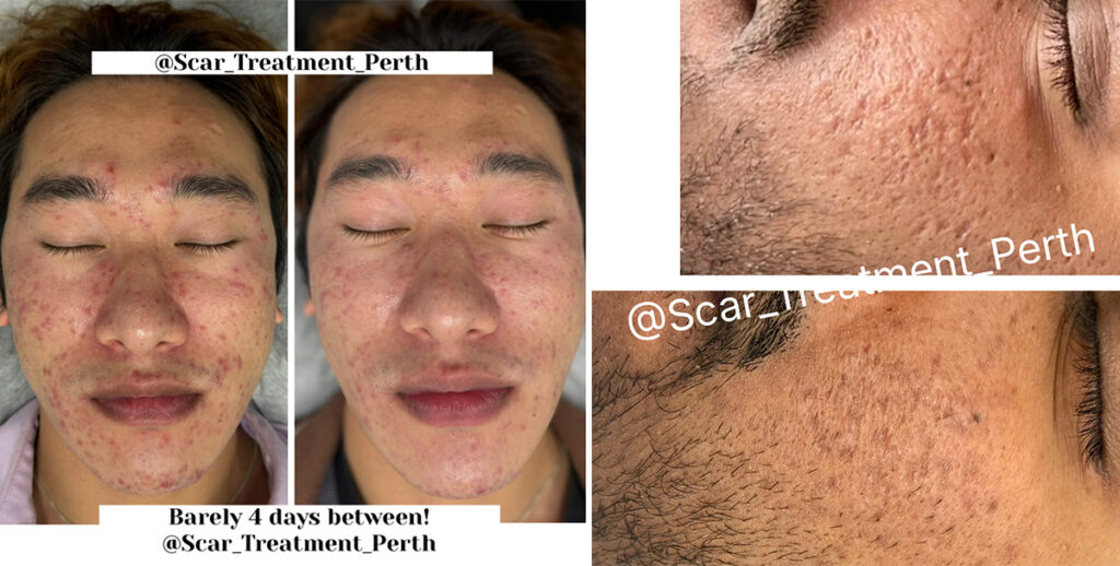 Skin Needling Perth
