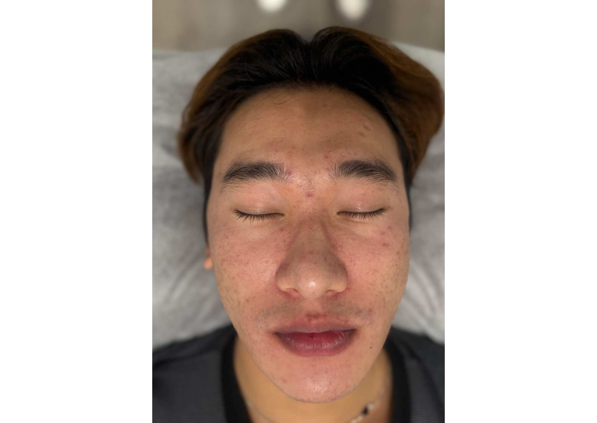 Acne Treatment Perth & Acne Scarring Expectations